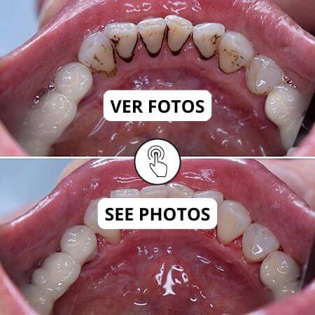 Limpieza dental