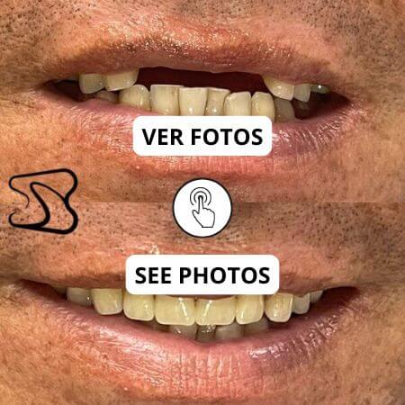 Prótesis dental