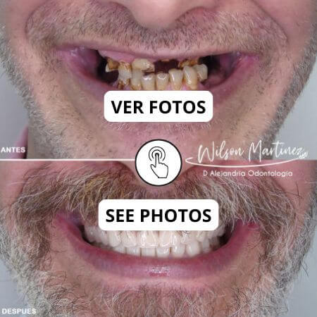 Rehabilitación oral