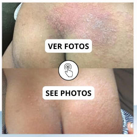 Alergias