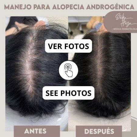 Alopecia