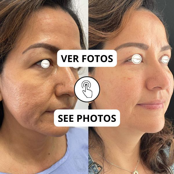 Ultherapy