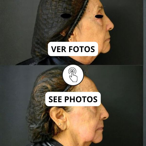 Dermazoom