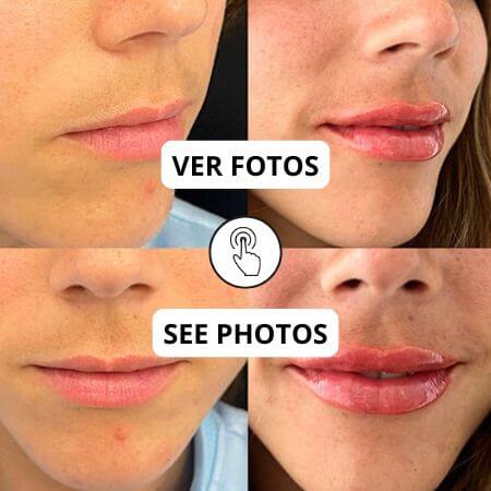 Aumento de labios