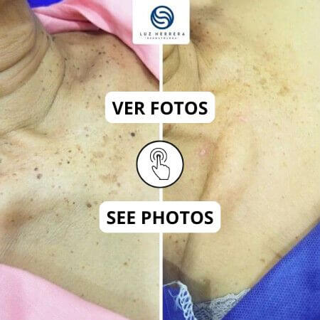 Cauterización de lesiones