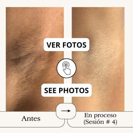 Depilación laser