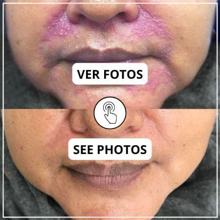 Dermatitis