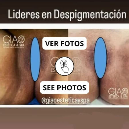 Blanqueamiento genital