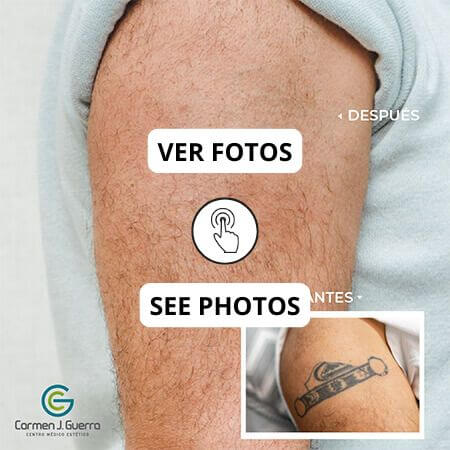 Eliminación de tatuajes