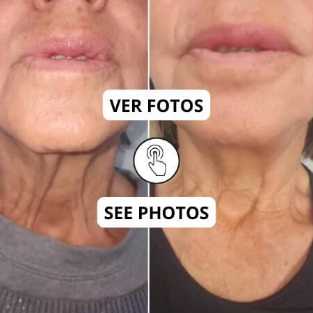 Rejuvenecimiento de cuello