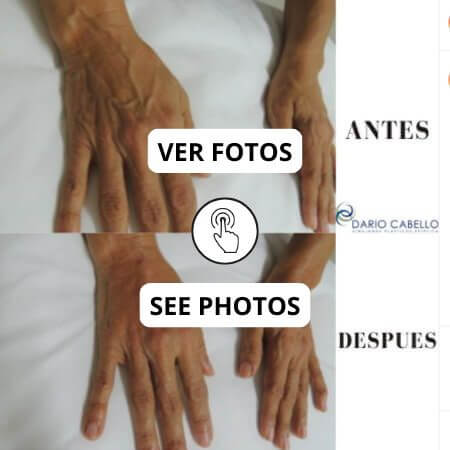 Rejuvenecimiento de manos