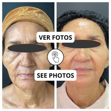 Rejuvenecimiento facial