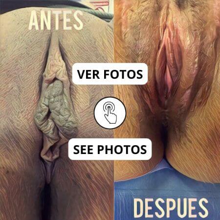 Rejuvenecimiento vaginal