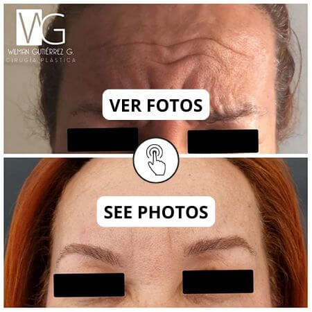 Toxina botulínica