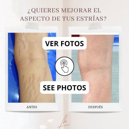Estrías