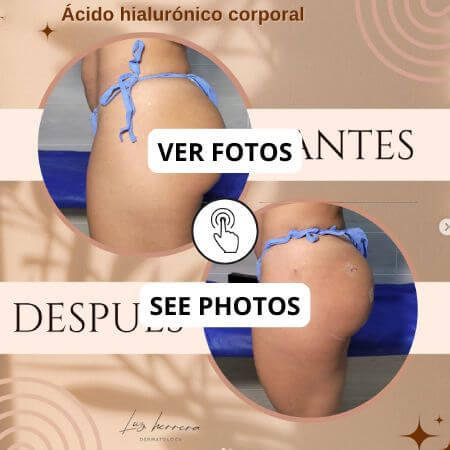 Glúteos