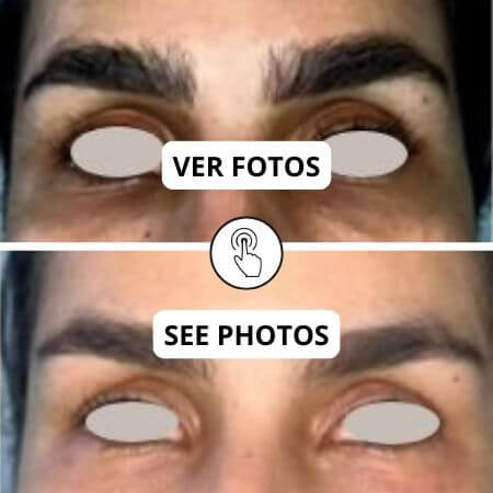 Ojeras