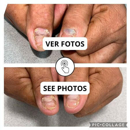 Tratamiento para uñas