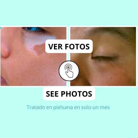 Vitiligo