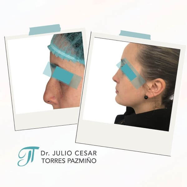 Nose Job