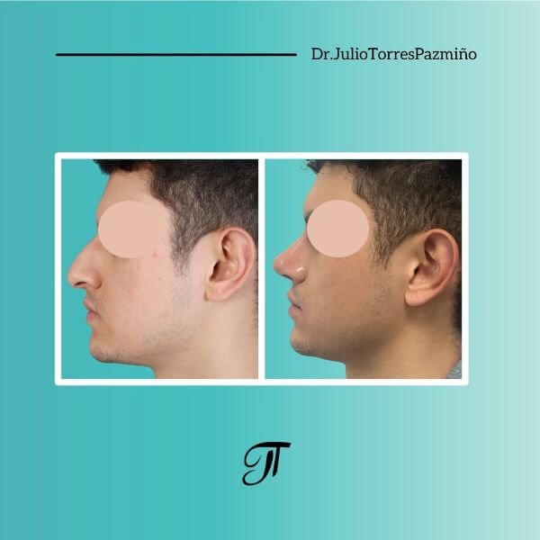 Masculine Nose Surgery