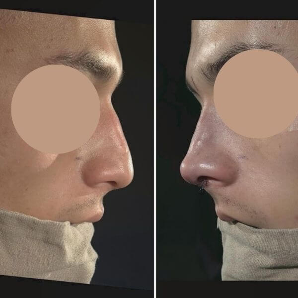 Masculine Nose Surgery
