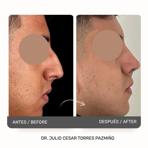 Masculine Nose Surgery