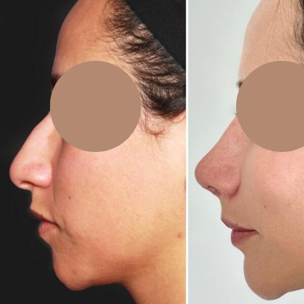 Nose Job
