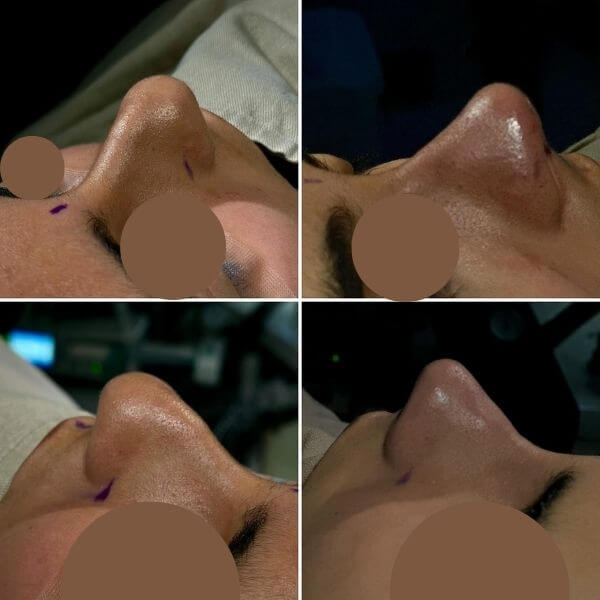 Nose Job