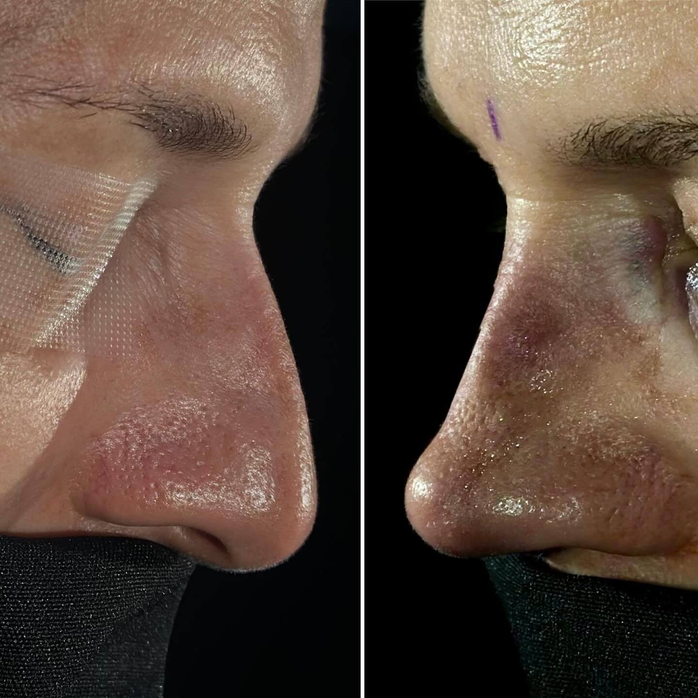Nose Job