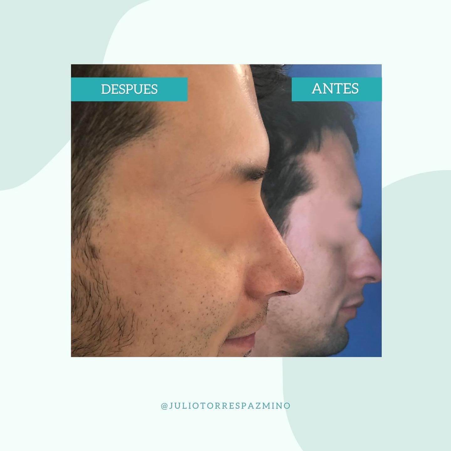 Masculine Nose Surgery