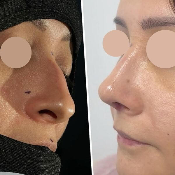 Nose Job