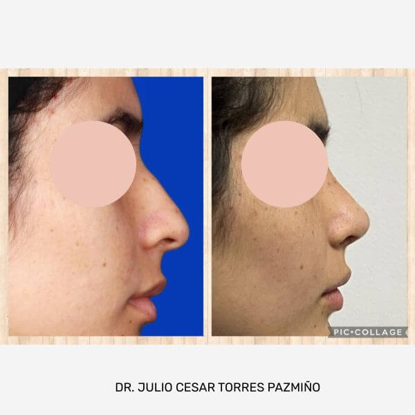 Nose Job