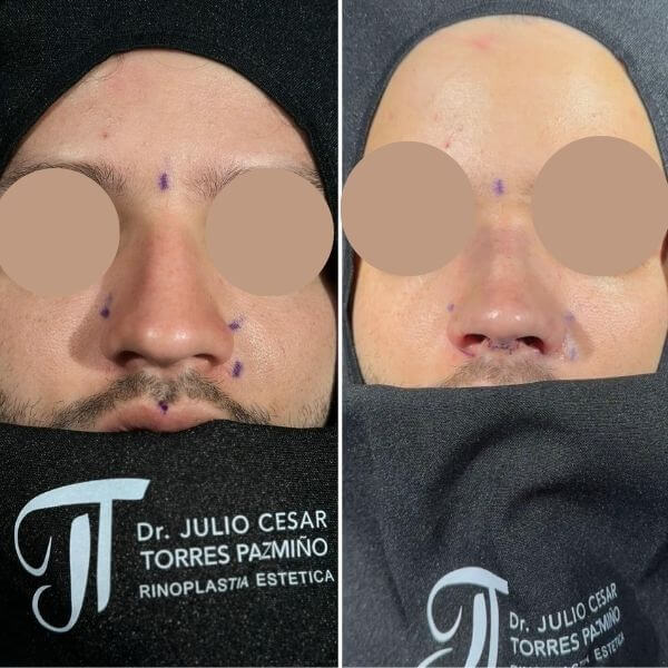 Nose Job