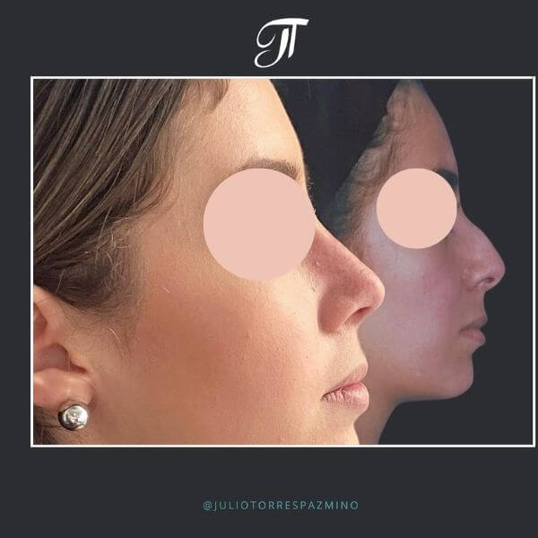 Nose Job