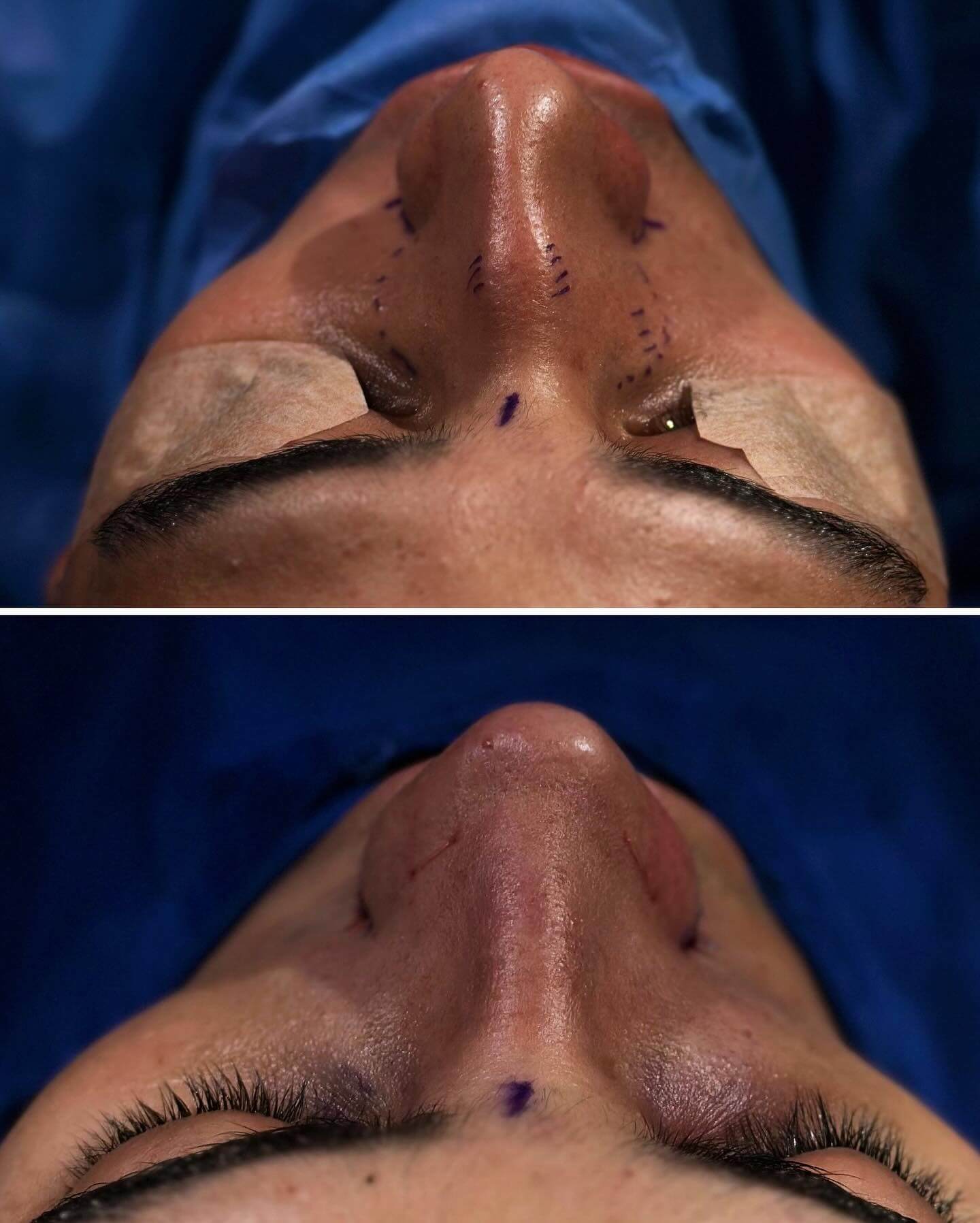 Nose Job