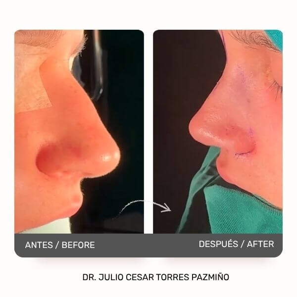 Nose Job