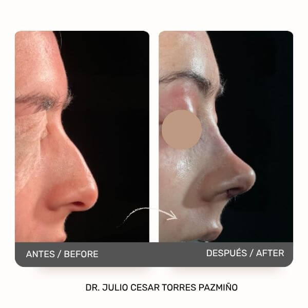 Nose Job