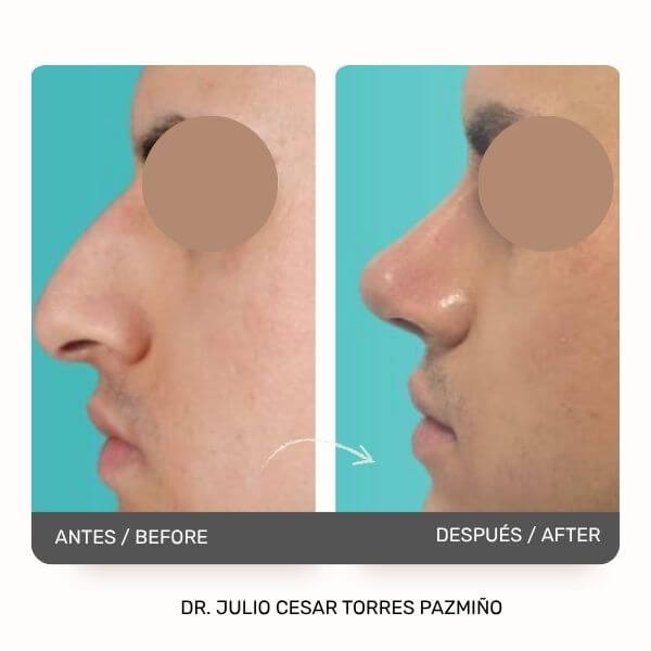 Masculine Nose Surgery