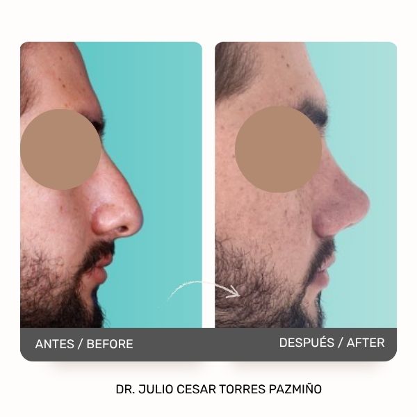 Masculine Nose Surgery