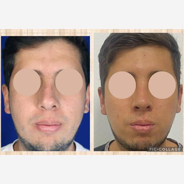 Masculine Nose Surgery