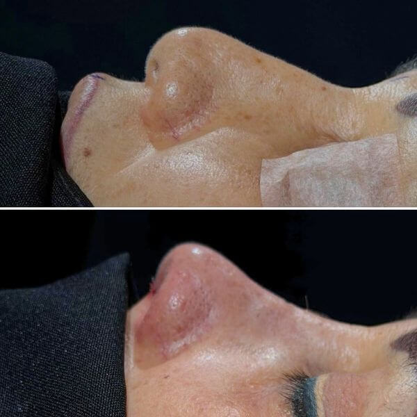 Nose Job