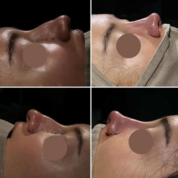 Nose Job