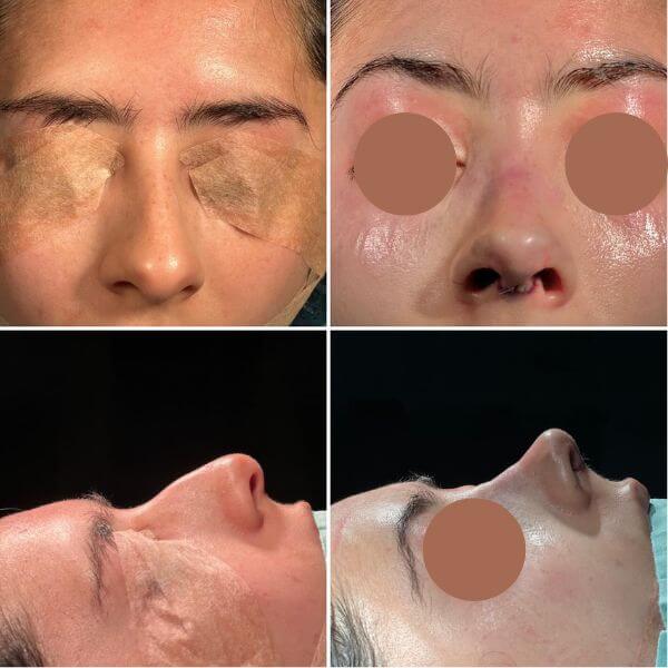 Nose Job