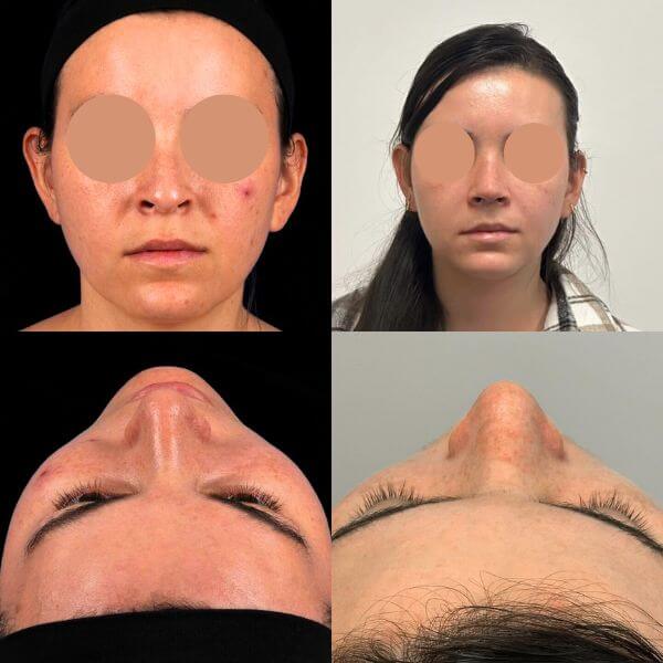 Nose Job