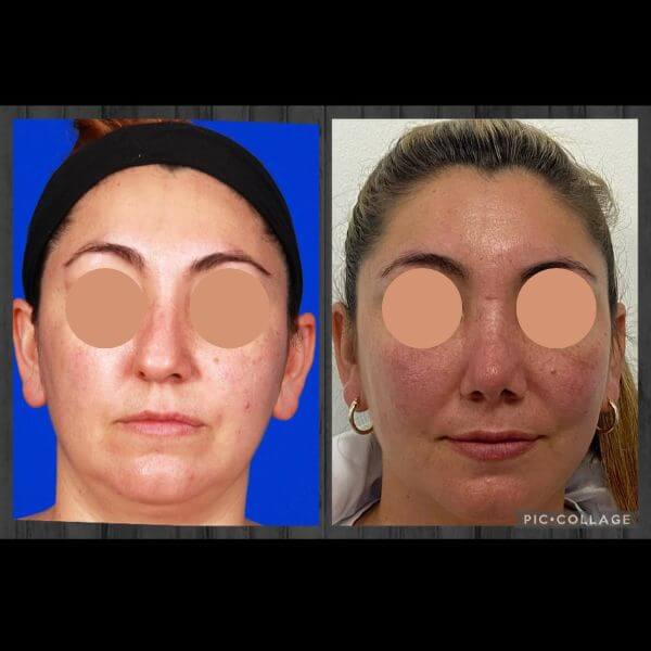 Nose Job