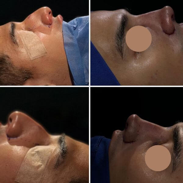 Masculine Nose Surgery