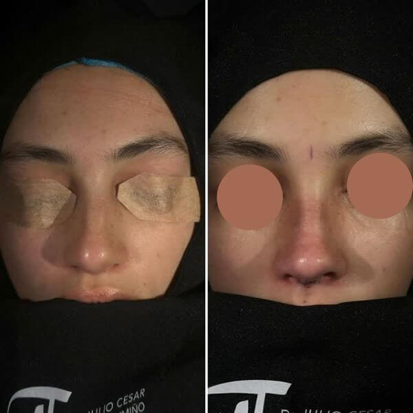 Nose Job