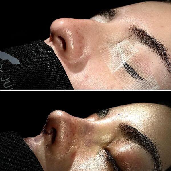 Nose Job
