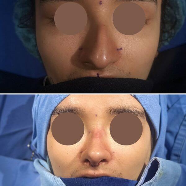 Masculine Nose Surgery